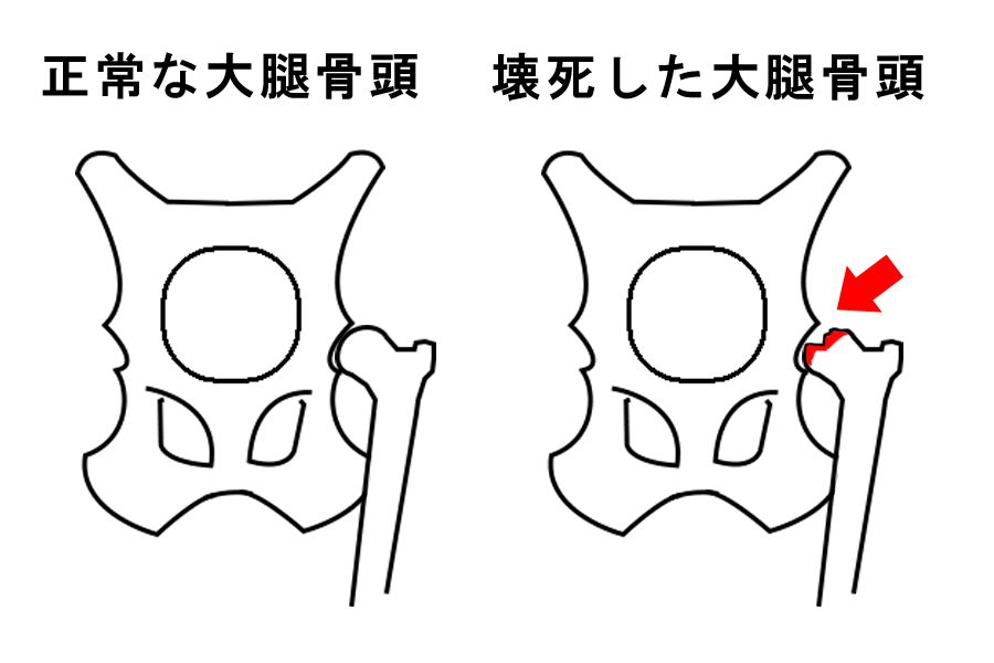 レッグペルテス レッグペルテス