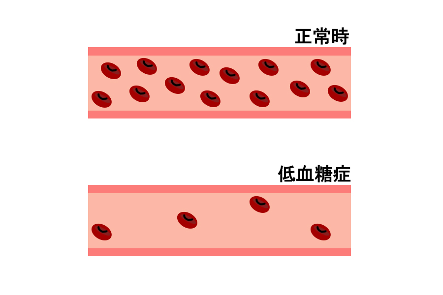 低血糖 低血糖