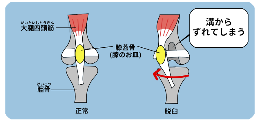 脱臼のしくみ 脱臼のしくみ